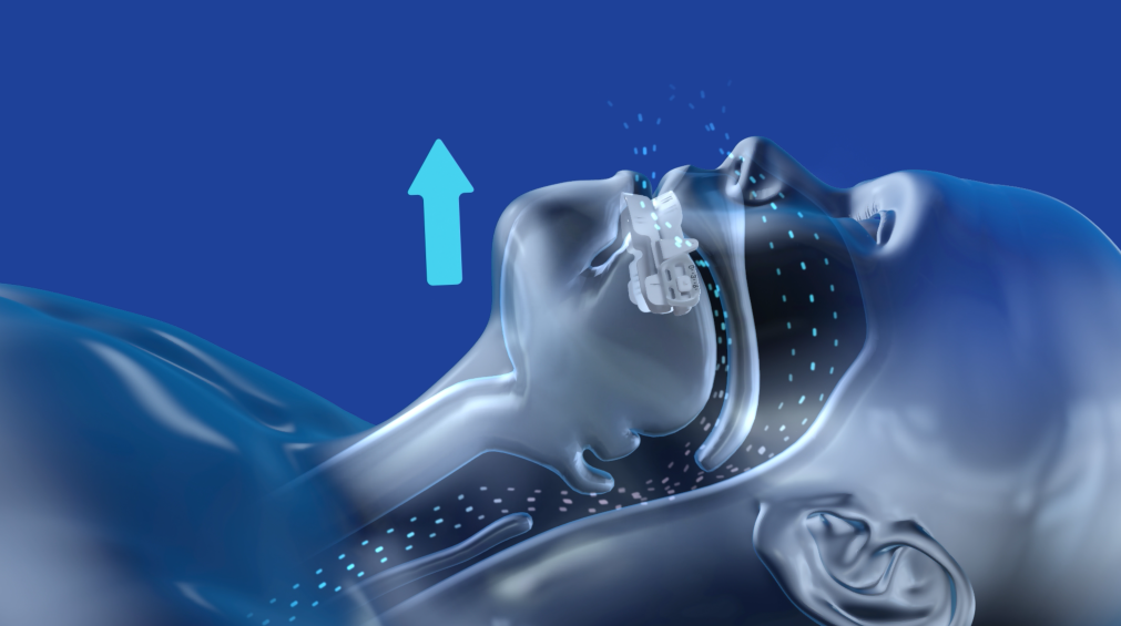 thumbnail video image 2 of SleepRight Snore Aid – Mouthguard, FDA-Approved for Snoring, Includes Top & Bottom Trays & Case, 1 Count, 2 of 12