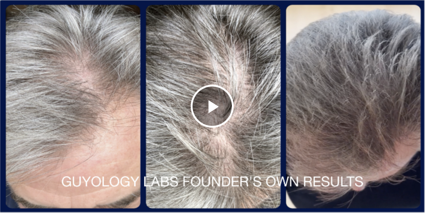 thumbnail video image 2 of Head Massager for Hair Growth - Hair Loss Shampoo Shower Brush - Soft Silicone Scalp Scrubber for Dandruff Removal - Scalp Scrub Wash Tool, 2 of 7